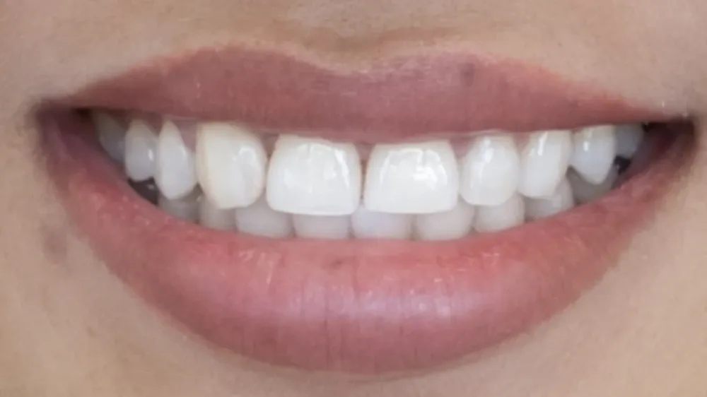 Smile transformation one, after treatment
