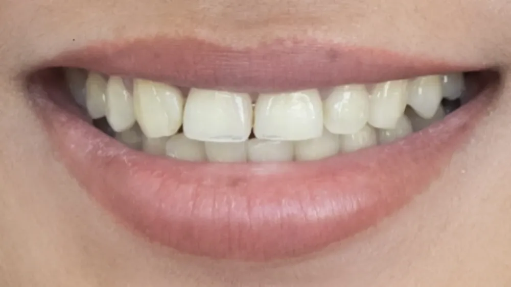 Smile transformation one, before treatment