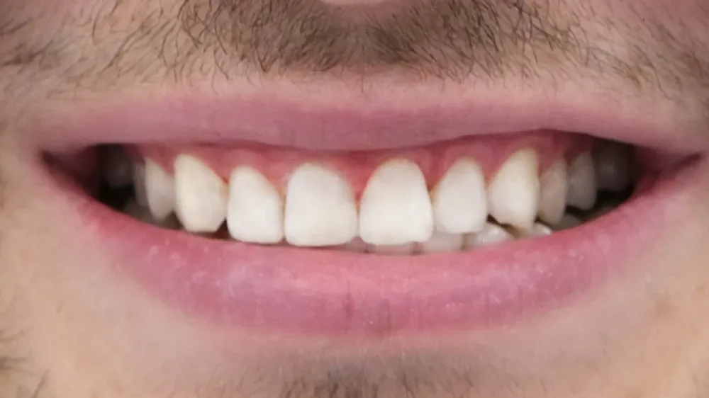 Smile transformation two, before treatment